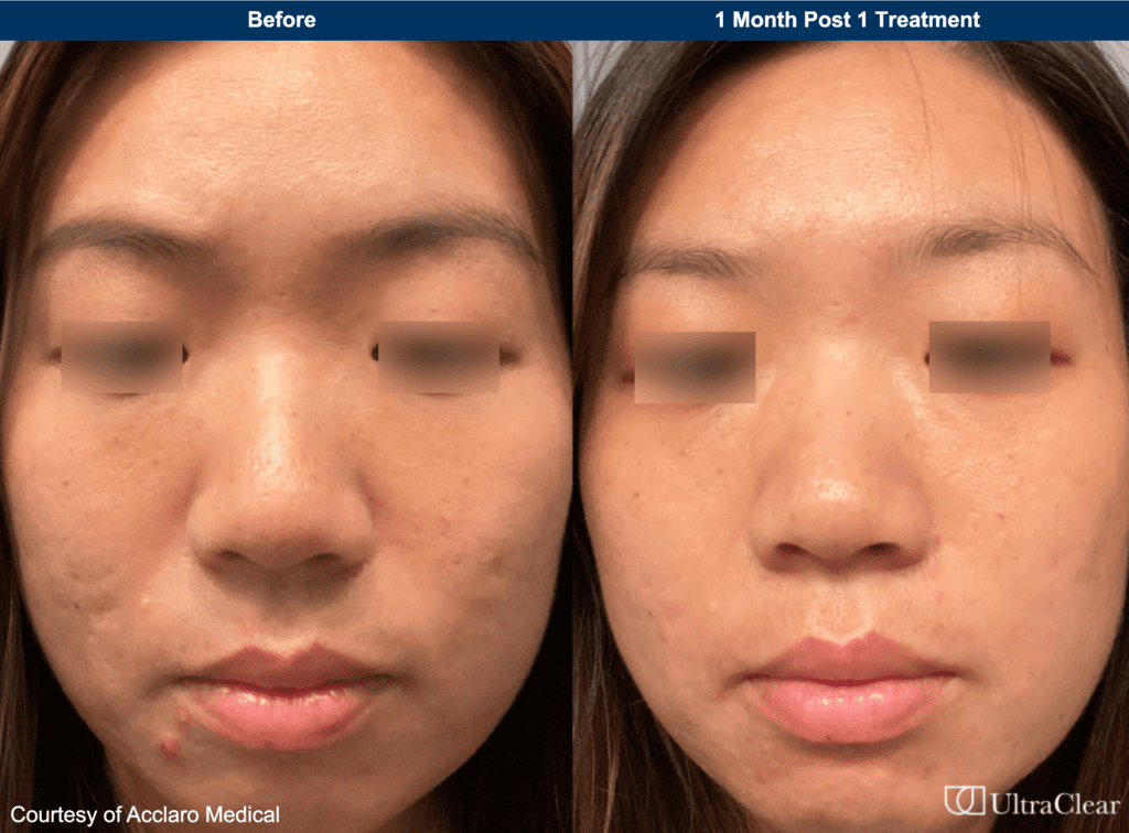 ultraclear laser before and after