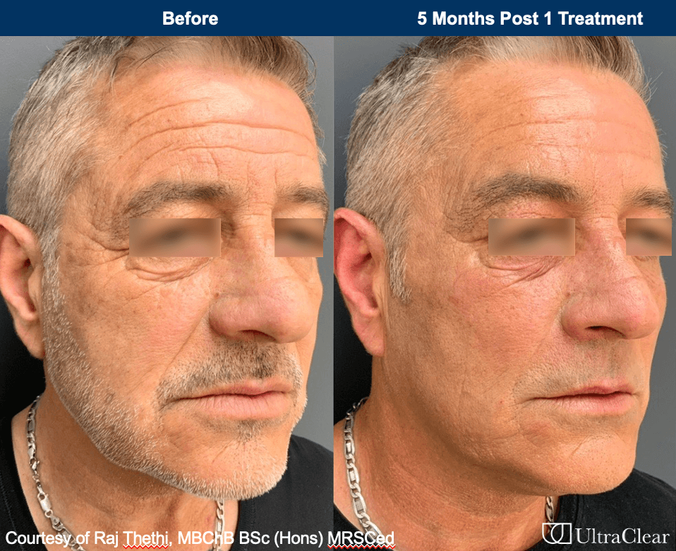 Before and after image of a man who had UltraClear laser treatment