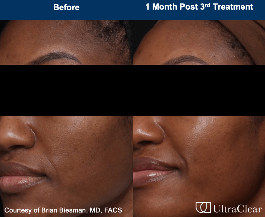 Before & after image of a african amerian woman who received UltraClear laser treatment on face