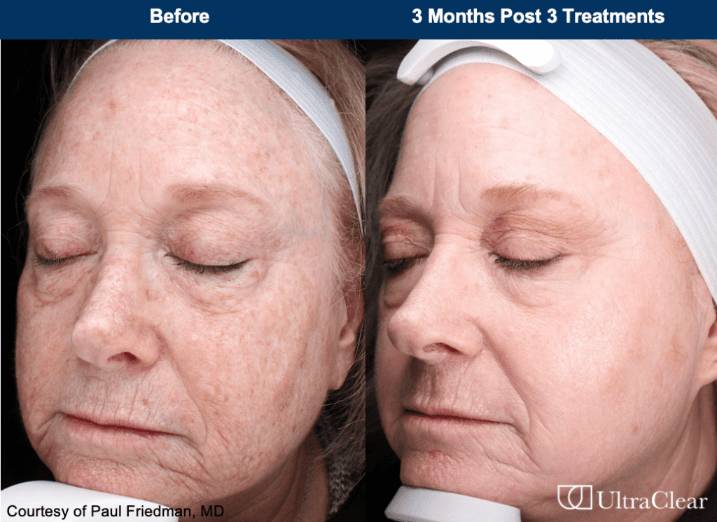 Before & after image of a woman's face who had UltraClear Laser treatment